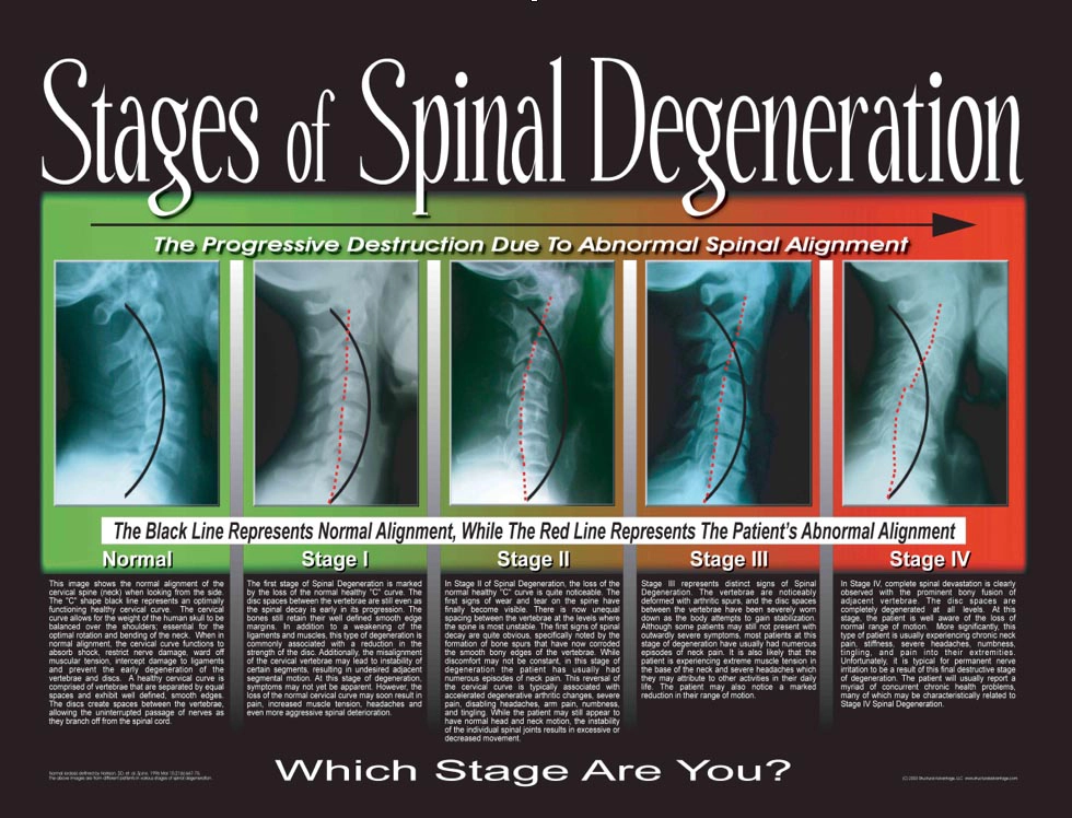 Chiropractic Katy TX Stages Of Neuro-Structural Abnormalities